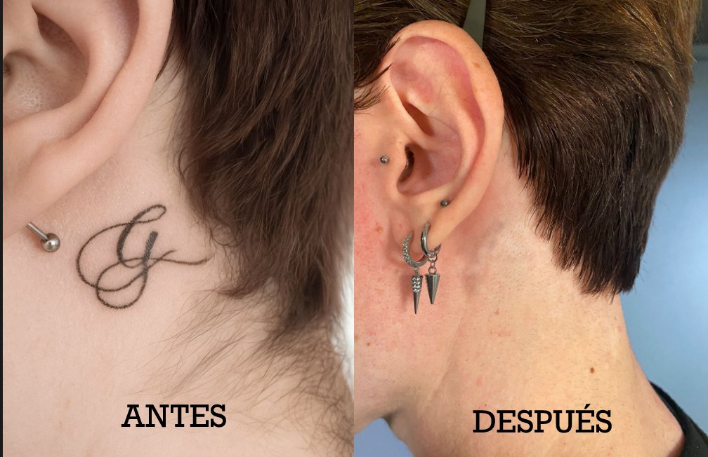 Tatuaje en el cuello antes y después del tratamiento con láser PicoSure